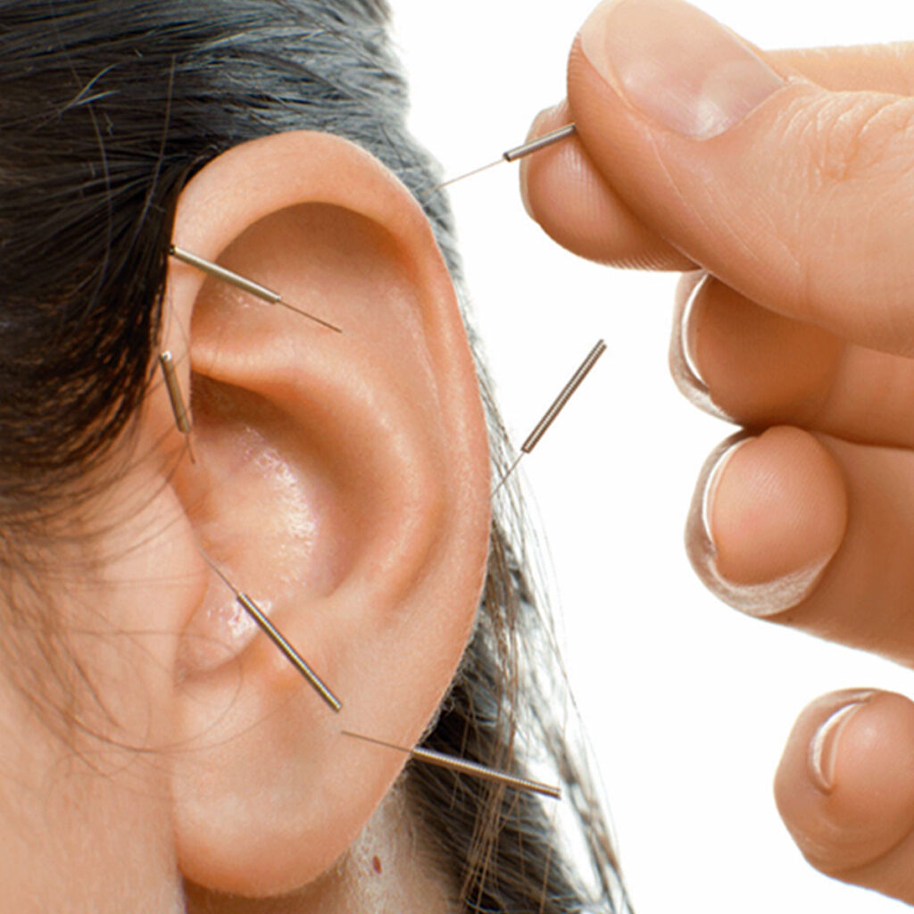 Sesión de Auriculoterapia medicinal
